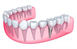 Benefits of Dental Implants