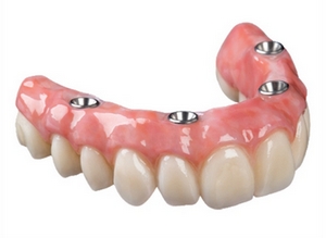 Implant Supported Dentures