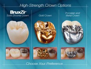 BruxZir® Solid Zirconia - Dr. Natalya Carmichael General & Cosmetic ...