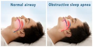 Obstructive Sleep Apnea