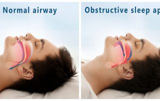 Obstructive Sleep Apnea
