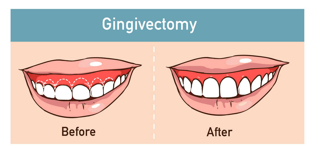 Gingivectomy-01 - Dr. Natalya Carmichael General & Cosmetic Dentistry ...