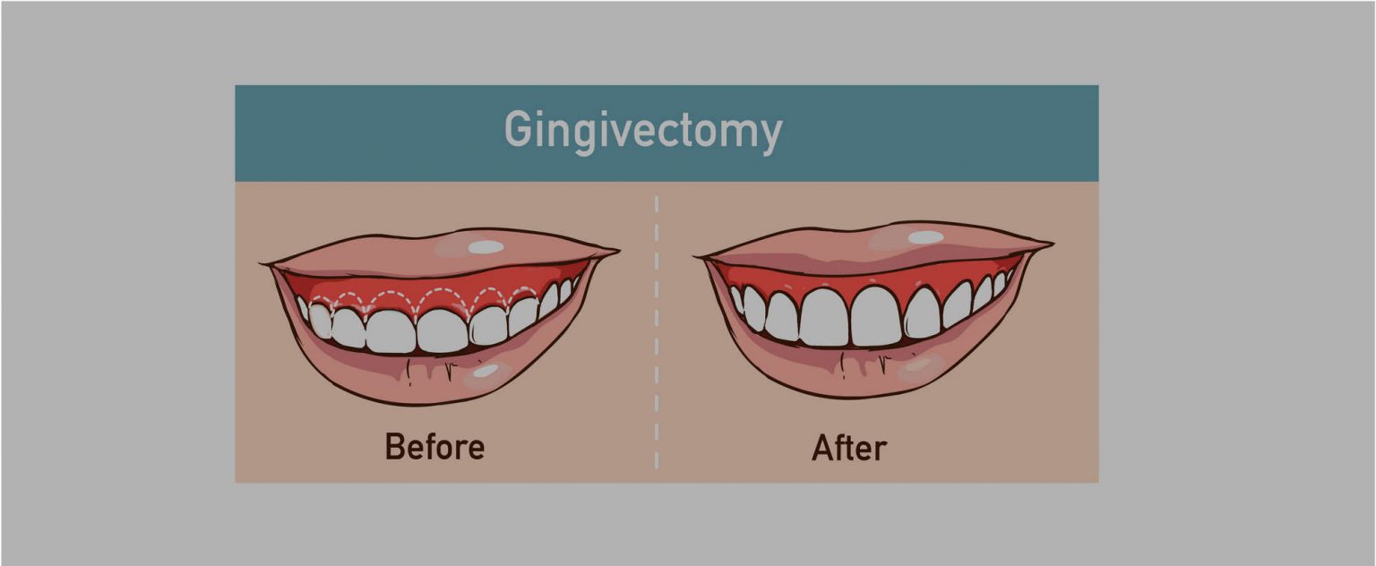 GingivectomyBeforeAfter Dr. Natalya Carmichael General & Cosmetic