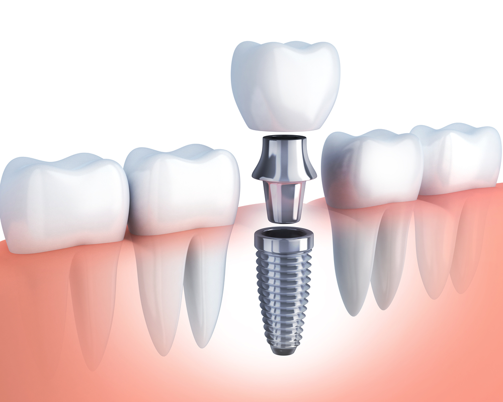 Dental Implant 