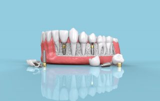 Dental Implants FAQs
