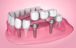 Dental Bridges Explained