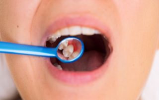 Periodontitis Increases Risk of Death in COVID-19 Patients