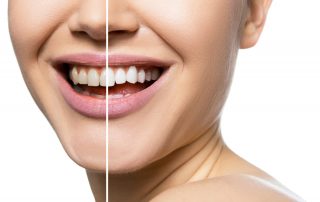 Teeth Whitening Explained