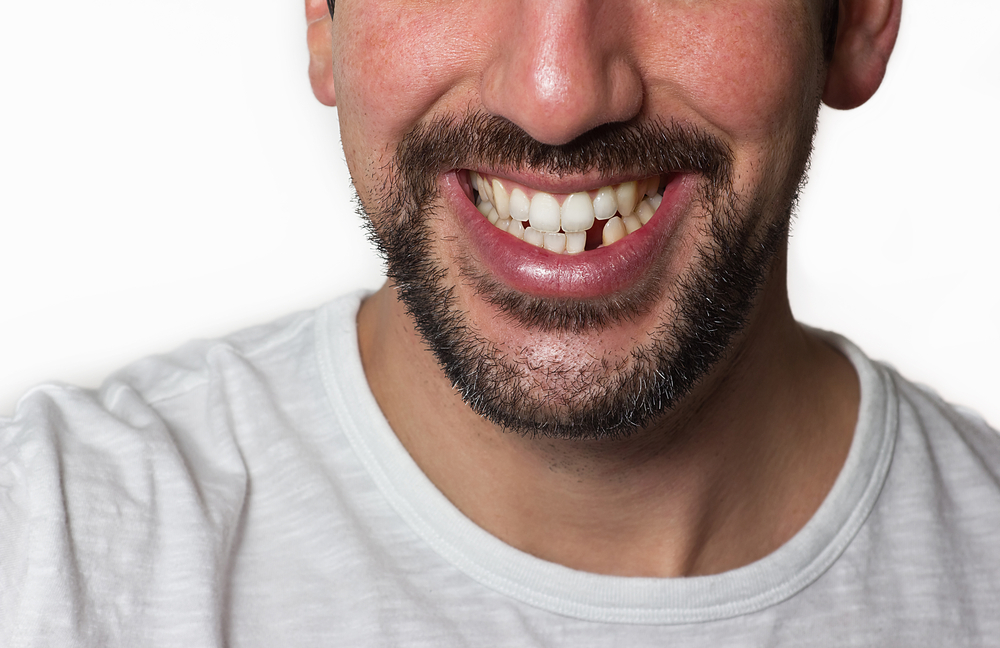 Everything You Need to Know About Bone Grafting for Dental Implants