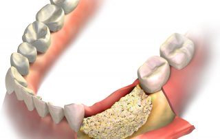 Everything You Need to Know About Bone Grafting for Dental Implants