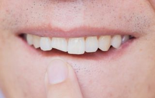 Man with chipped tooth