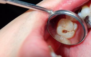 Tooth with cavity