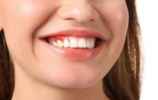 Woman with gum disease