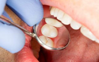 Composite Fillings in San Diego