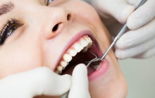 Dental Fillings in San Diego