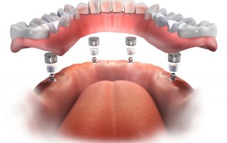 Permanent Dentures