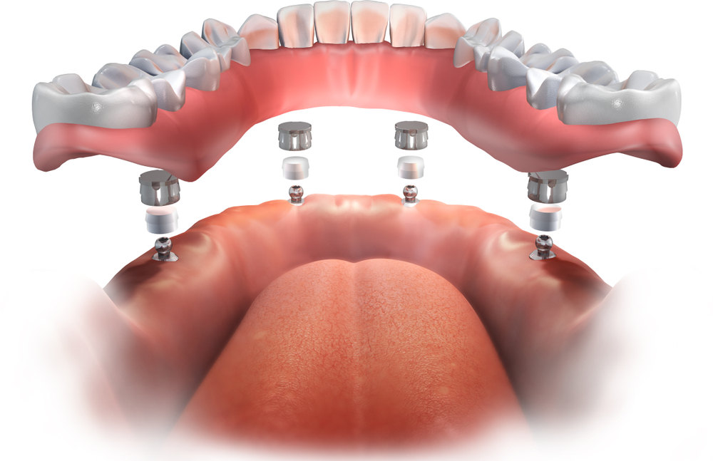 When To Get False Teeth