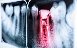 X-Ray of Tooth Canal (Tooth Decay)