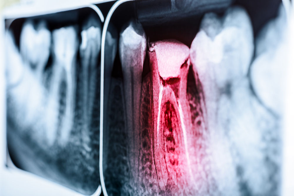 X-Ray of Tooth Canal (Tooth Decay)