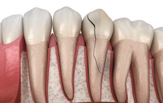 Cracked Tooth (Can A Cracked Tooth Heal On Its Own)
