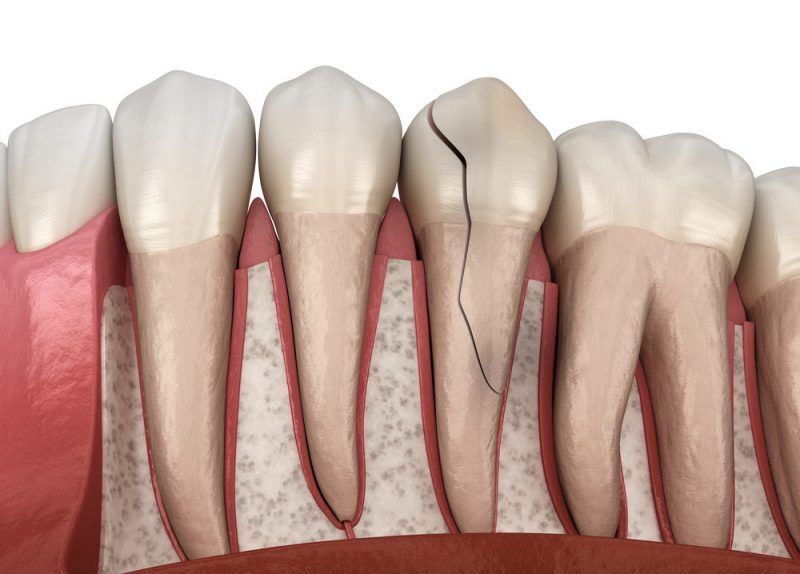 cracked-tooth-5-types-and-how-to-treat-them