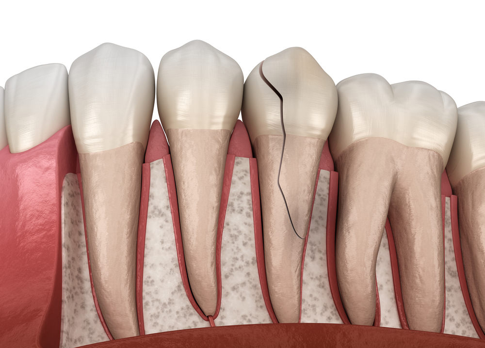 Chipped or Cracked Tooth Causes and Repair - Crest