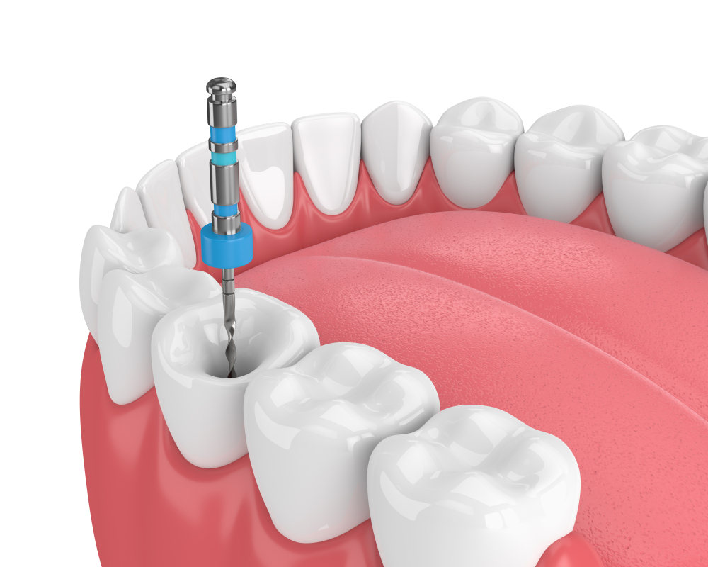 Can teeth repair themselves without fillings? 