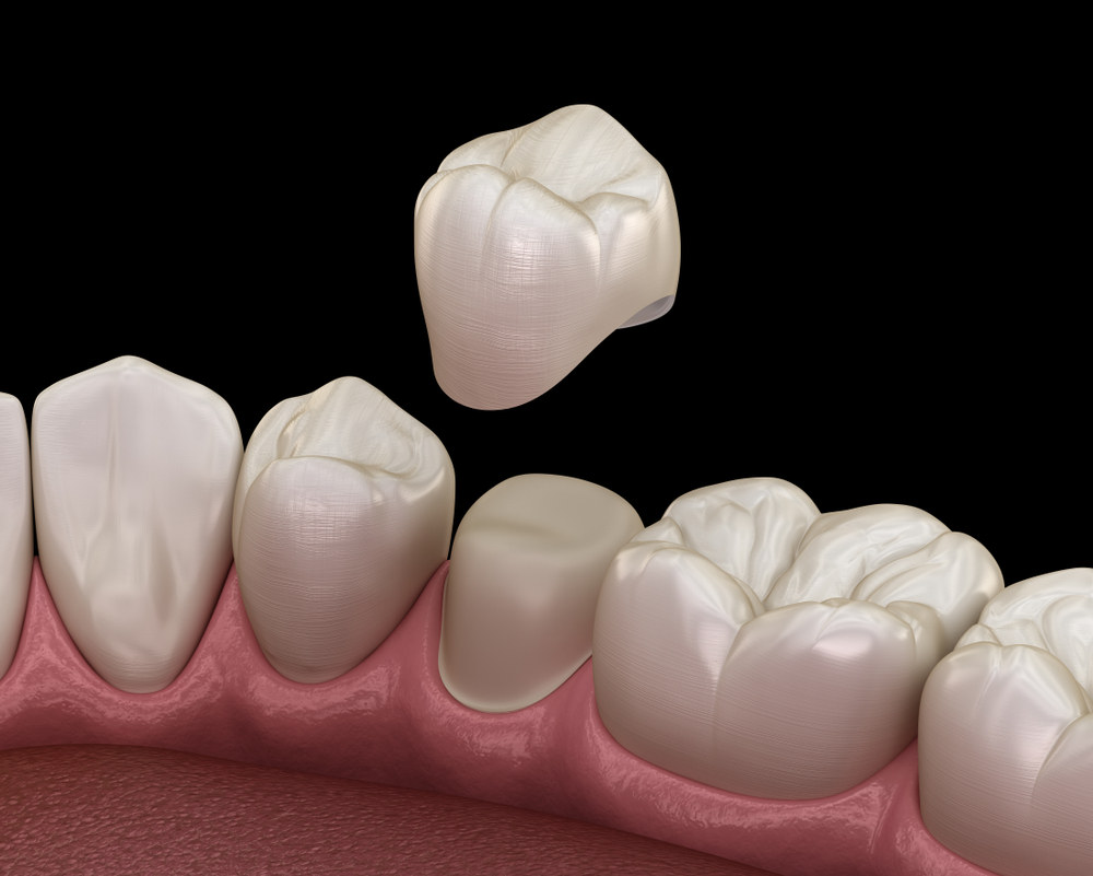 Dental crown placement (Top 5 Benefits of Dental Crowns)