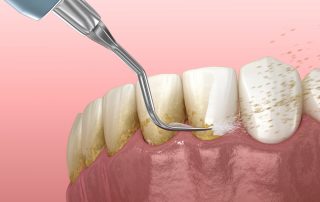 Teeth Scaling What You Need to Know