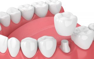 dental crown restoration