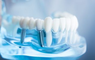 Carmichael Dentistry Blog #2 Best Dental Implants in San Diego