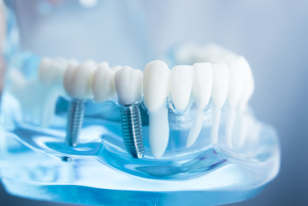 Carmichael Dentistry Blog #2 Best Dental Implants in San Diego