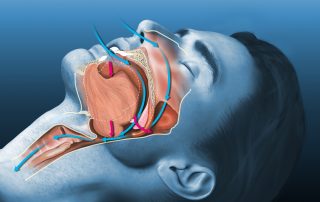 Sleep Apnea, Its Symptoms, and Treatment