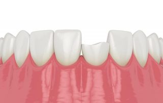 4 Options for Fixing a Chipped Tooth