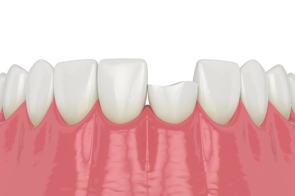 4 Options for Fixing a Chipped Tooth