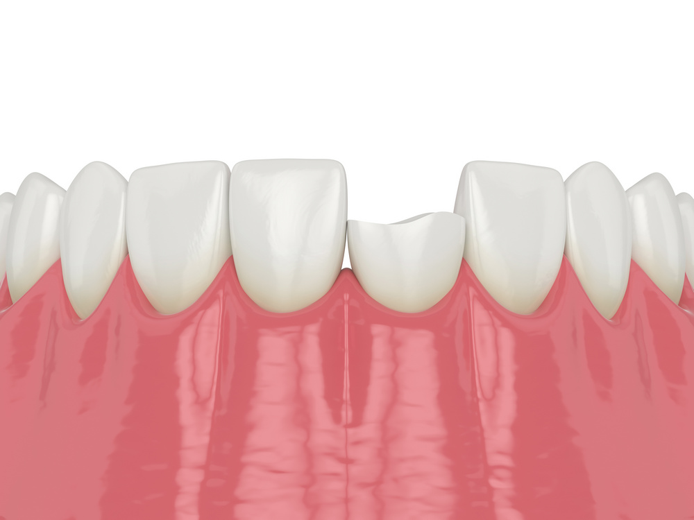 4 Options for Fixing a Chipped Tooth