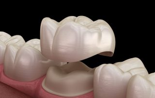 Helpful Insights on Dental Crowns