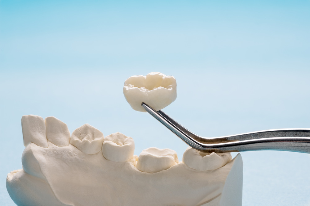 Why You Might Need a Dental Crown