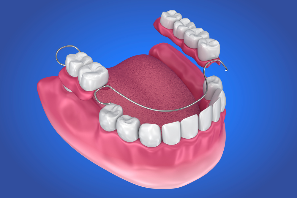 Understanding Partial Dentures
