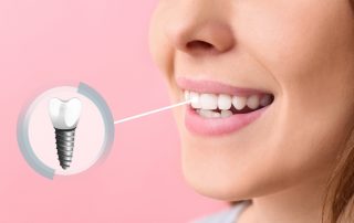 Dental Implants: Why Your Jawbone Needs Them