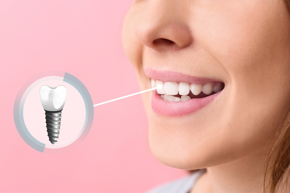 Dental Implants: Why Your Jawbone Needs Them