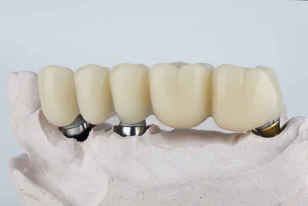 5 Reasons People Choose Dental Bridges