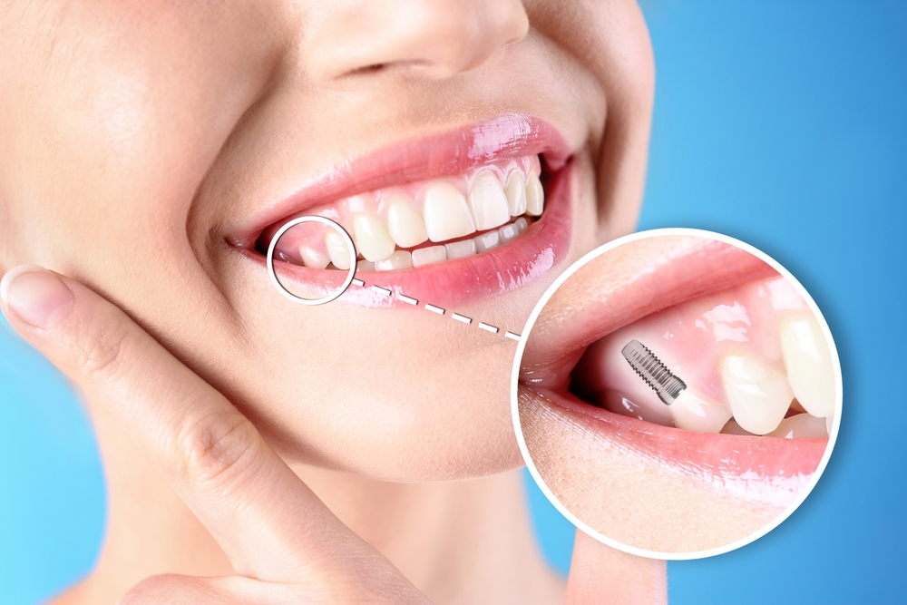 Are Dental Implants a Good Option for Missing Teeth?