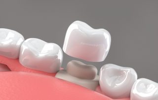 Restoring Smiles The Aesthetic Benefits of Dental Crowns