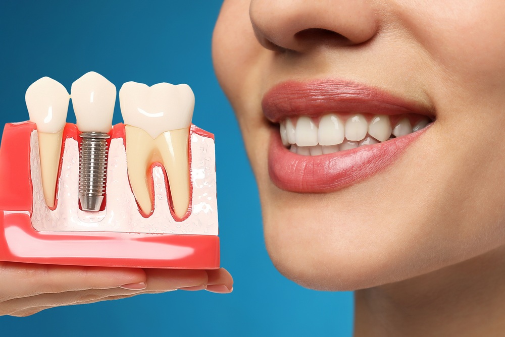 The Benefits of Dental Implants: Why They're a Superior Choice
