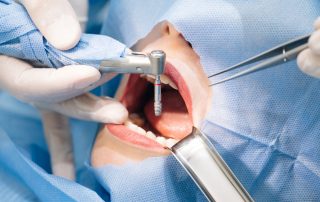 What's the Recovery Process Like for Dental Implants?