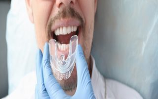 Why Custom Athletic and Night Mouthguards Protect Your Teeth and Improve Comfort