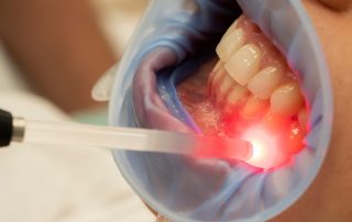 Transform Your Smile with Carmichael DDS Laser Gum Disease Treatment