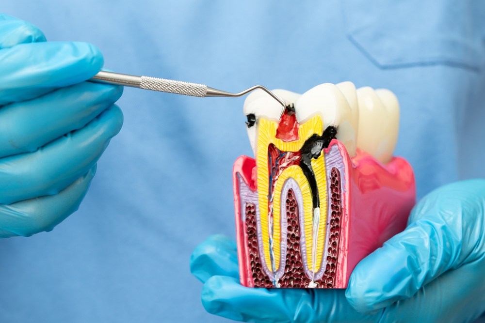 How to Know If a Toothache Needs a Root Canal or Emergency Dental Visit
