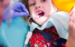 When Dental Sealants Are a Smart Choice for Cavity Prevention in Children and Teens